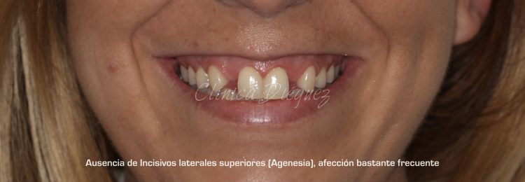 Antes